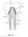 Fig. 41 - DENTAL PROSTHESES DEVICES AND METHODS