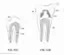 Fig. 42 - DENTAL PROSTHESES DEVICES AND METHODS