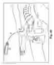 Fig. 28 - Surgical articles and methods