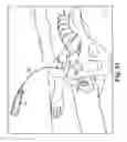 Fig. 29 - Surgical articles and methods