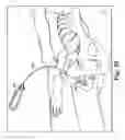Fig. 30 - Surgical articles and methods