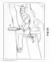 Fig. 31 - Surgical articles and methods
