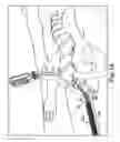 Fig. 32 - Surgical articles and methods