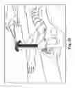 Fig. 33 - Surgical articles and methods