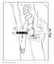 Fig. 34 - Surgical articles and methods