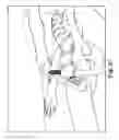 Fig. 35 - Surgical articles and methods