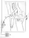 Fig. 38 - Surgical articles and methods