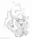 Fig. 05 - Mitral valve prosthesis