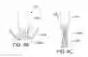 Fig. 06 - Mitral valve prosthesis