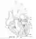 Fig. 07 - Mitral valve prosthesis