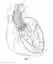 Fig. 02 - Systems for replacing a native heart valve and aorta with a prosthetic heart valve and conduit