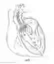 Fig. 05 - Systems for replacing a native heart valve and aorta with a prosthetic heart valve and conduit