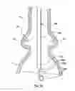 Fig. 10 - Delivery system having retractable wires as a coupling mechanism and a deployment mechanism for a self-expanding prosthesis