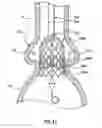 Fig. 12 - Delivery system having retractable wires as a coupling mechanism and a deployment mechanism for a self-expanding prosthesis