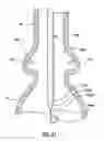Fig. 18 - Delivery system having retractable wires as a coupling mechanism and a deployment mechanism for a self-expanding prosthesis