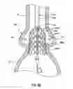 Fig. 19 - Delivery system having retractable wires as a coupling mechanism and a deployment mechanism for a self-expanding prosthesis