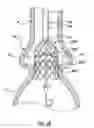 Fig. 20 - Delivery system having retractable wires as a coupling mechanism and a deployment mechanism for a self-expanding prosthesis