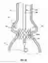 Fig. 23 - Delivery system having retractable wires as a coupling mechanism and a deployment mechanism for a self-expanding prosthesis
