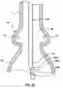 Fig. 10 - Delivery system having retractable wires as a coupling mechanism and a deployment mechanism for a self-expanding prosthesis