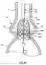 Fig. 11 - Delivery system having retractable wires as a coupling mechanism and a deployment mechanism for a self-expanding prosthesis