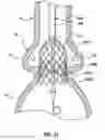 Fig. 12 - Delivery system having retractable wires as a coupling mechanism and a deployment mechanism for a self-expanding prosthesis