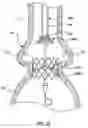 Fig. 14 - Delivery system having retractable wires as a coupling mechanism and a deployment mechanism for a self-expanding prosthesis