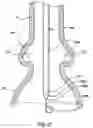 Fig. 18 - Delivery system having retractable wires as a coupling mechanism and a deployment mechanism for a self-expanding prosthesis