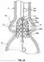 Fig. 19 - Delivery system having retractable wires as a coupling mechanism and a deployment mechanism for a self-expanding prosthesis