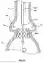 Fig. 22 - Delivery system having retractable wires as a coupling mechanism and a deployment mechanism for a self-expanding prosthesis