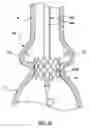 Fig. 23 - Delivery system having retractable wires as a coupling mechanism and a deployment mechanism for a self-expanding prosthesis