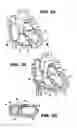 Fig. 02 - Method and device for percutaneous left ventricular reconstruction