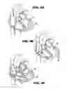 Fig. 05 - Method and device for percutaneous left ventricular reconstruction