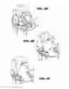 Fig. 06 - Method and device for percutaneous left ventricular reconstruction