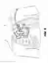 Fig. 07 - Method and device for percutaneous left ventricular reconstruction