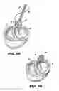 Fig. 08 - Method and device for percutaneous left ventricular reconstruction