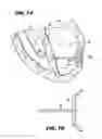 Fig. 09 - Method and device for percutaneous left ventricular reconstruction