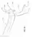 Fig. 30 - Internal joint stabilizer device, system and method of use