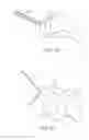 Fig. 11 - Partial joint resurfacing implant,instrumentation, and method
