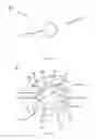 Fig. 40 - Partial joint resurfacing implant,instrumentation, and method