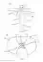 Fig. 44 - Partial joint resurfacing implant,instrumentation, and method