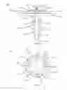 Fig. 51 - Partial joint resurfacing implant,instrumentation, and method