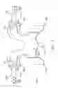 Fig. 04 - Prothesis for the replacement of a posterior element of a vertebra