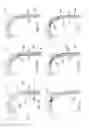 Fig. 08 - Methods of implanting a prosthesis
