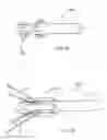Fig. 10 - Methods of implanting a prosthesis
