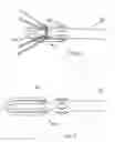 Fig. 11 - Methods of implanting a prosthesis