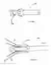 Fig. 10 - Methods of implanting a prosthesis and treating an aneurysm