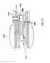 Fig. 12 - Methods of implanting a prosthesis and treating an aneurysm