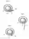 Fig. 10 - Method and instrument for treating obesity