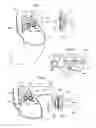 Fig. 11 - Method and instrument for treating obesity