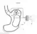 Fig. 15 - Method and instrument for treating obesity